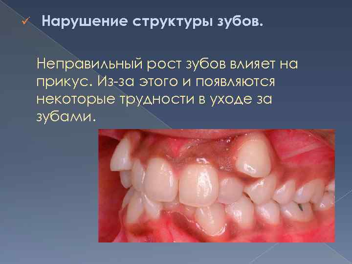 ü Нарушение структуры зубов. Неправильный рост зубов влияет на прикус. Из-за этого и появляются