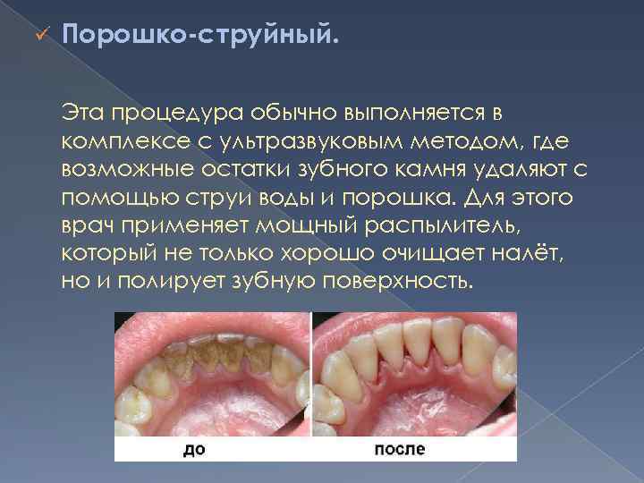ü Порошко-струйный. Эта процедура обычно выполняется в комплексе с ультразвуковым методом, где возможные остатки