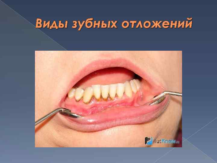Виды зубных отложений 