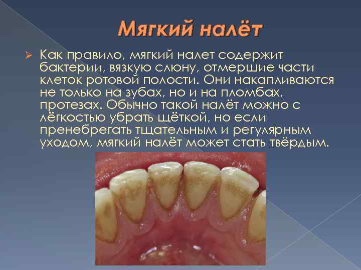 Мягкий налёт Ø Как правило, мягкий налет содержит бактерии, вязкую слюну, отмершие части клеток