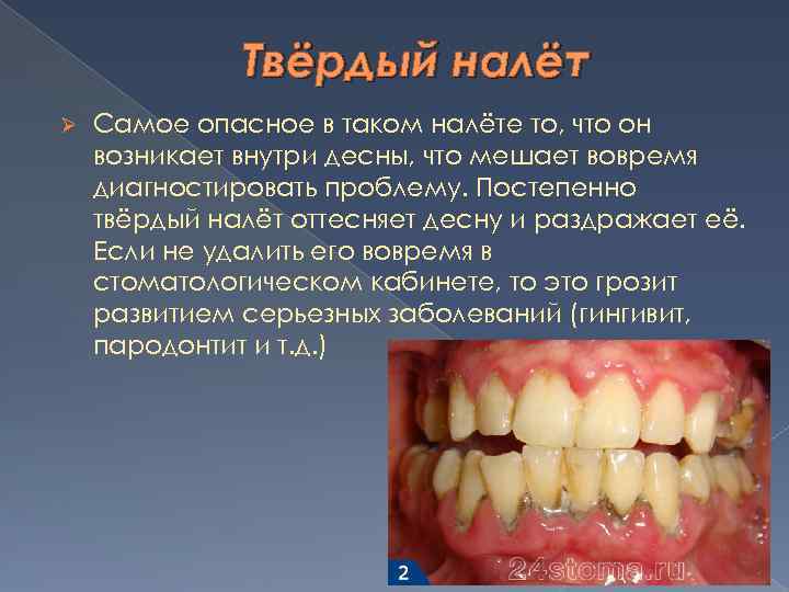 Твёрдый налёт Ø Самое опасное в таком налёте то, что он возникает внутри десны,