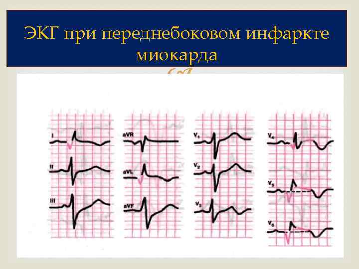 ЭКГ при переднебоковом инфаркте миокарда 