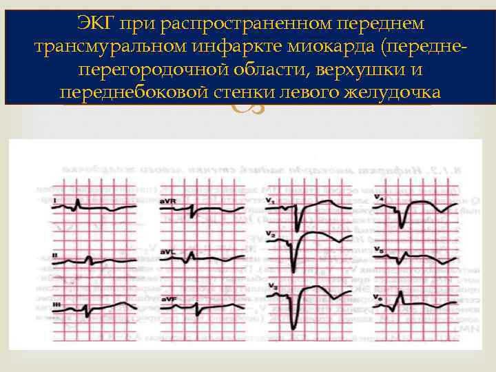 ЭКГ при распространенном переднем трансмуральном инфаркте миокарда (переднеперегородочной области, верхушки и переднебоковой стенки левого