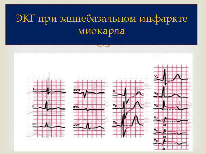 ЭКГ при заднебазальном инфаркте миокарда 