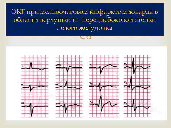 ЭКГ при мелкоочаговом инфаркте миокарда в области верхушки и переднебоковой стенки левого желудочка 