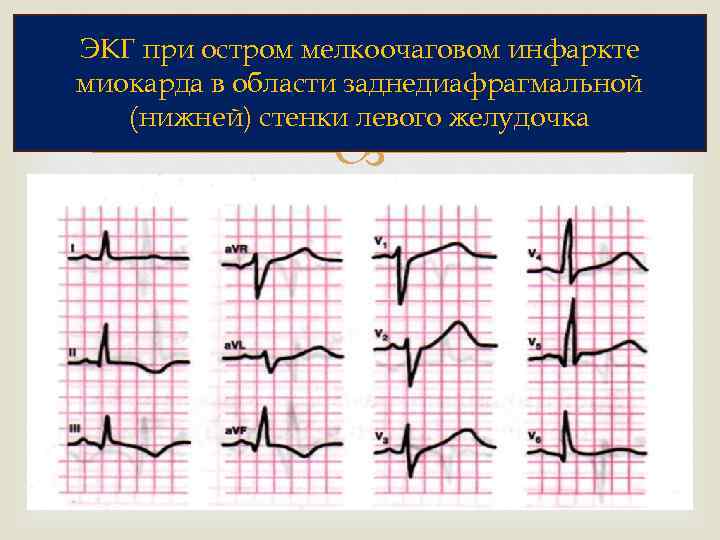 ЭКГ при остром мелкоочаговом инфаркте миокарда в области заднедиафрагмальной (нижней) стенки левого желудочка 