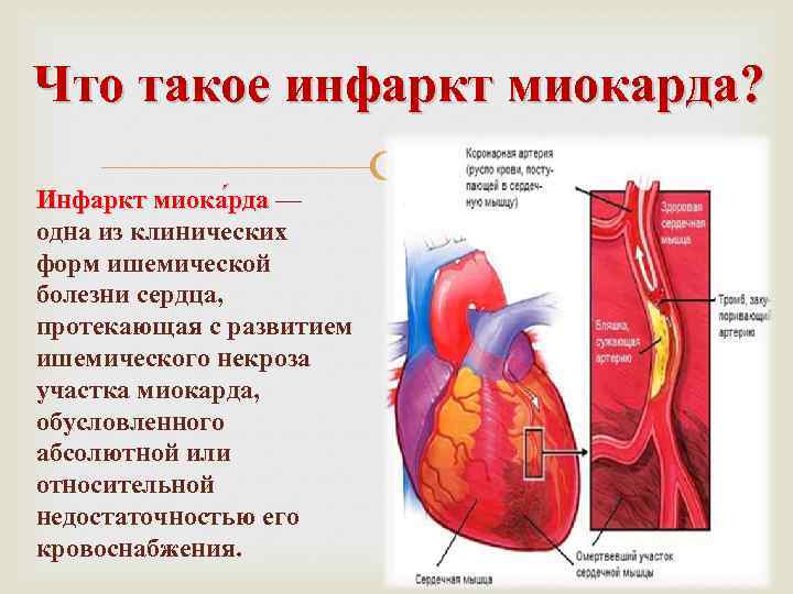 Что такое инфаркт миокарда? Инфаркт миока рда — да одна из клинических форм ишемической