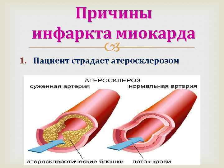 Причины инфаркта миокарда 1. Пациент страдает атеросклерозом 