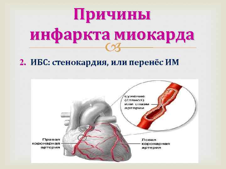 Причины инфаркта миокарда 2. ИБС: стенокардия, или перенёс ИМ 