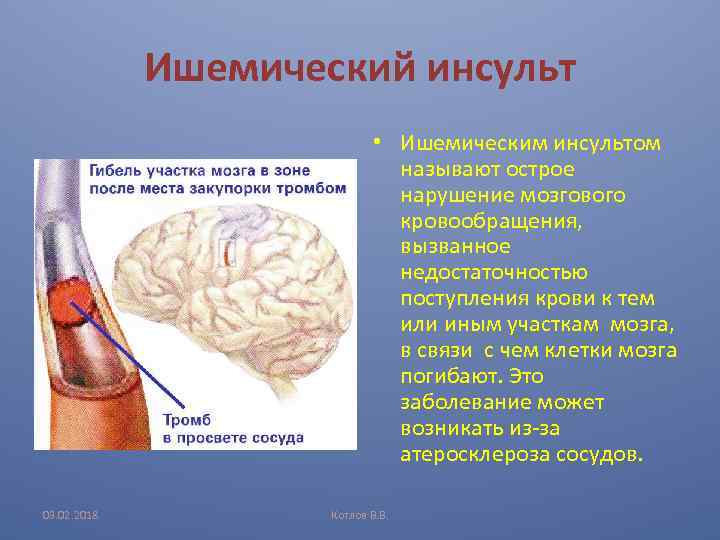 Ишемический инсульт • Ишемическим инсультом называют острое нарушение мозгового кровообращения, вызванное недостаточностью поступления крови