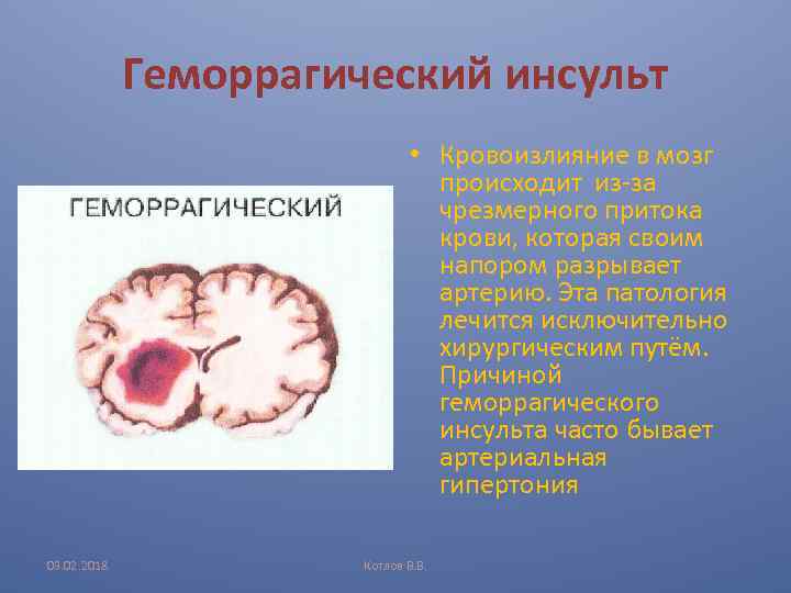 Геморрагический инсульт • Кровоизлияние в мозг происходит из-за чрезмерного притока крови, которая своим напором