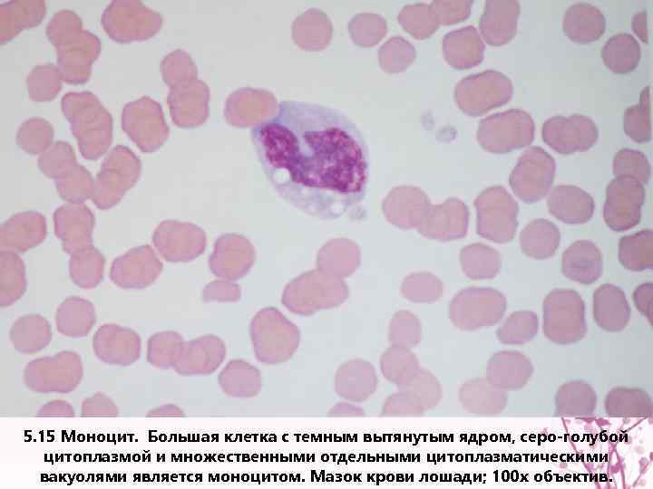 5. 15 Моноцит. Большая клетка с темным вытянутым ядром, серо-голубой цитоплазмой и множественными отдельными