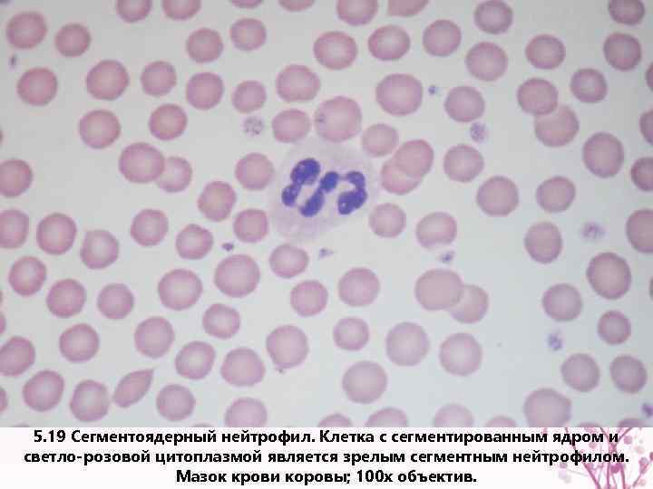 5. 19 Сегментоядерный нейтрофил. Клетка с сегментированным ядром и светло-розовой цитоплазмой является зрелым сегментным