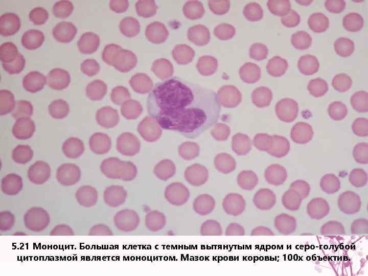 5. 21 Моноцит. Большая клетка с темным вытянутым ядром и серо-голубой цитоплазмой является моноцитом.