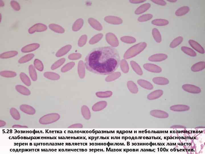 5. 28 Эозинофил. Клетка с палочкообразным ядром и небольшим количеством слабовыраженных маленьких, круглых или