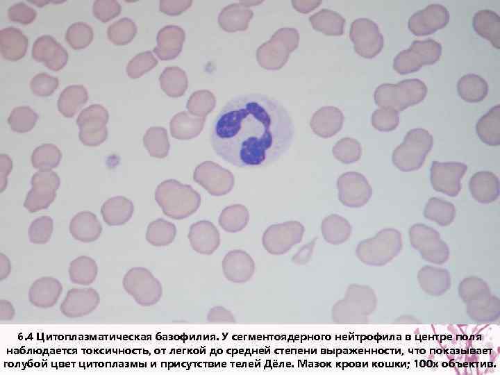 6. 4 Цитоплазматическая базофилия. У сегментоядерного нейтрофила в центре поля наблюдается токсичность, от легкой