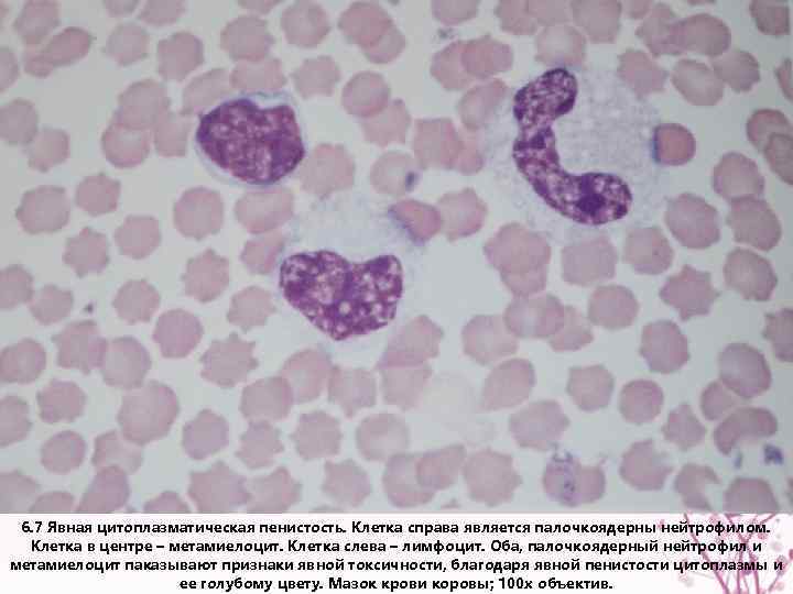6. 7 Явная цитоплазматическая пенистость. Клетка справа является палочкоядерны нейтрофилом. Клетка в центре –