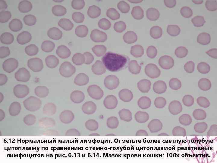 6. 12 Нормальный малый лимфоцит. Отметьте более светлую голубую цитоплазму по сравнению с темно-голубой