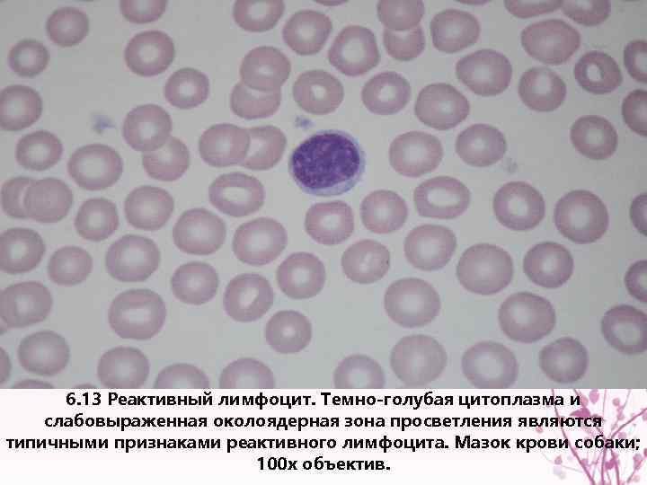 6. 13 Реактивный лимфоцит. Темно-голубая цитоплазма и слабовыраженная околоядерная зона просветления являются типичными признаками