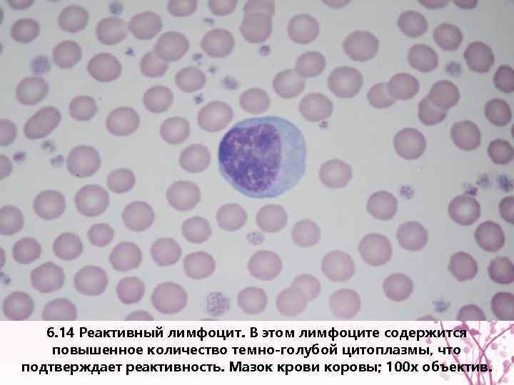 6. 14 Реактивный лимфоцит. В этом лимфоците содержится повышенное количество темно-голубой цитоплазмы, что подтверждает