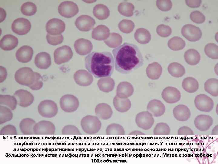 6. 15 Атипичные лимфоциты. Две клетки в центре с глубокими щелями в ядрах и