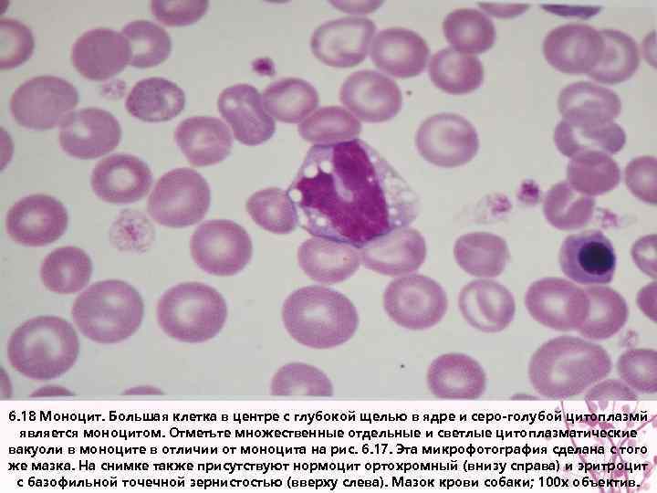 6. 18 Моноцит. Большая клетка в центре с глубокой щелью в ядре и серо-голубой