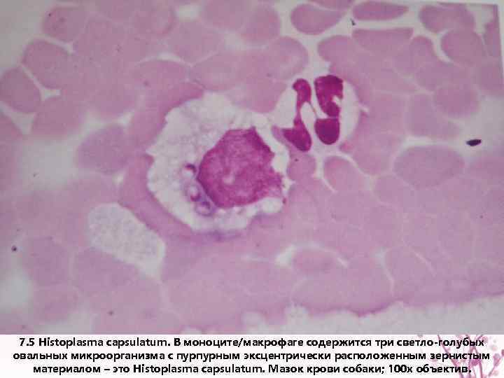 7. 5 Histoplasma capsulatum. В моноците/макрофаге содержится три светло-голубых овальных микроорганизма с пурпурным эксцентрически