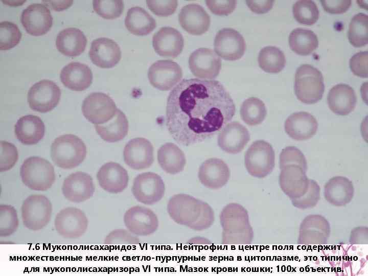 7. 6 Мукополисахаридоз VI типа. Нейтрофил в центре поля содержит множественные мелкие светло-пурпурные зерна