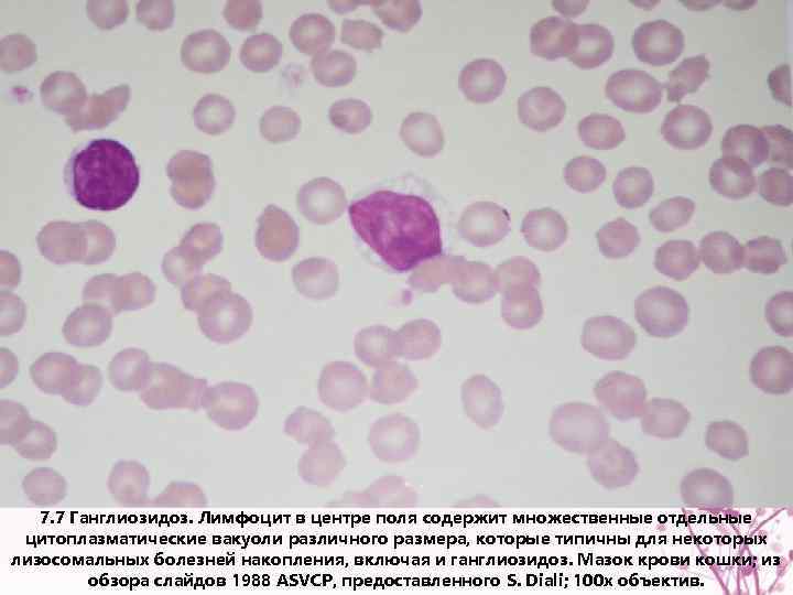 7. 7 Ганглиозидоз. Лимфоцит в центре поля содержит множественные отдельные цитоплазматические вакуоли различного размера,