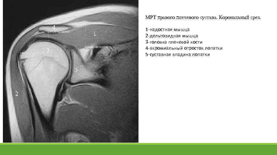 МРТ правого плечевого сустава. Корональный срез. 1 -надостная мышца 2 -дельтовидная мышца 3 -головка