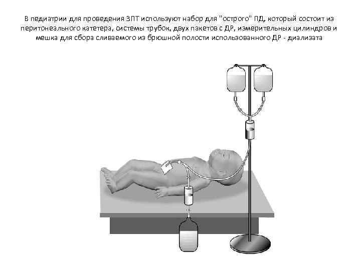 В педиатрии для проведения ЗПТ используют набор для "острого" ПД, который состоит из перитонеального
