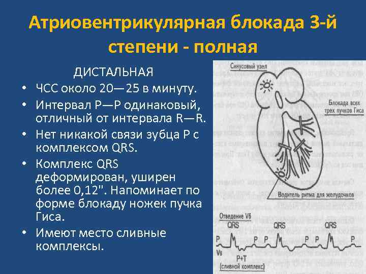 Атриовентрикулярная блокада 3 -й степени - полная • • • ДИСТАЛЬНАЯ ЧСС около 20—