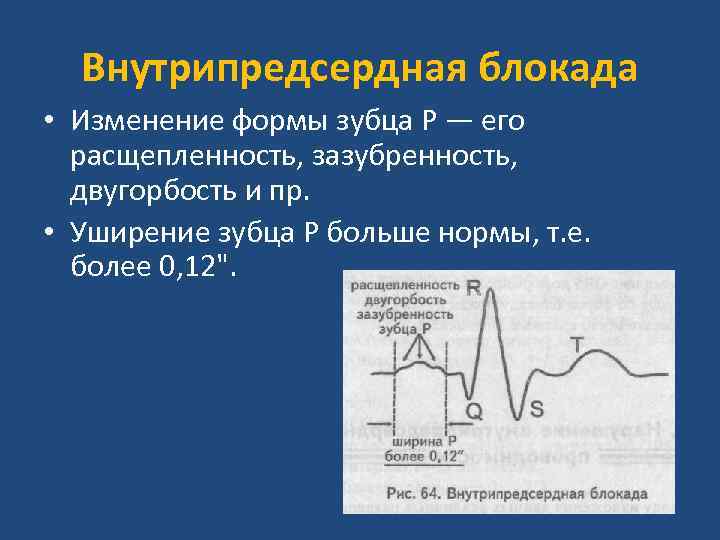 Внутрипредсердная проводимость