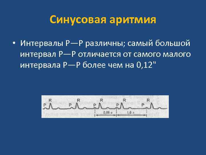 Синусовая аритмия. Синусовый ритм. Синусоидная аритмия что это. Синусовая аритмия механизм развития.