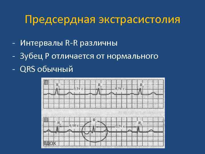 Предсердная экстрасистолия - Интервалы R-R различны - Зубец Р отличается от нормального - QRS