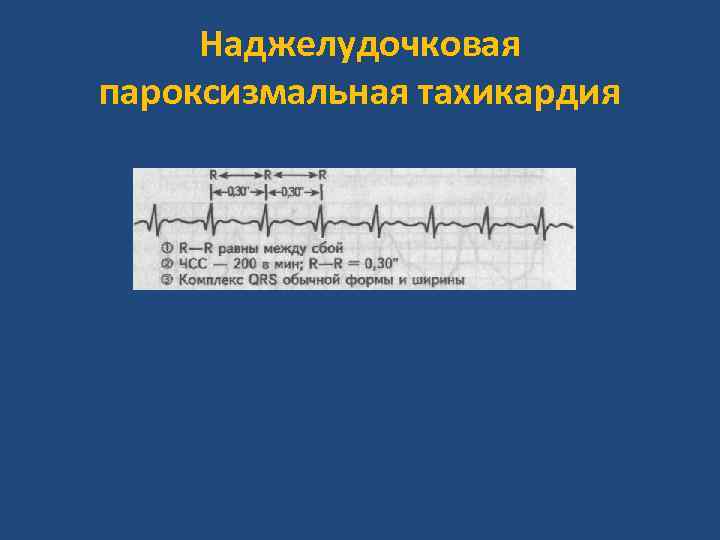 Наджелудочковая пароксизмальная тахикардия 