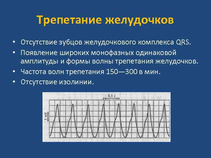Трепетание желудочков • Отсутствие зубцов желудочкового комплекса QRS. • Появление широких монофазных одинаковой амплитуды