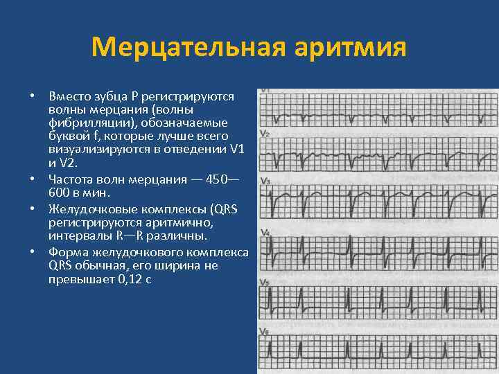 Мерцательная аритмия карта вызова