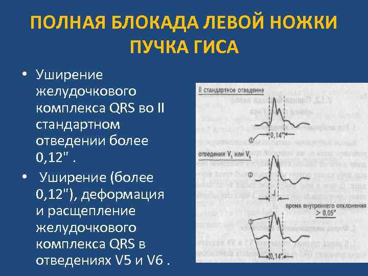 Полная блокада левой ножки гиса