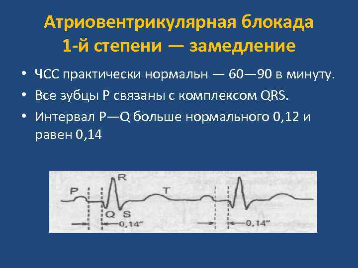 Атриовентрикулярная блокада 1 -й степени — замедление • ЧСС практически нормальн — 60— 90