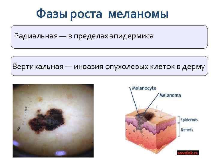 Фазы роста меланомы Радиальная — в пределах эпидермиса Вертикальная — инвазия опухолевых клеток в