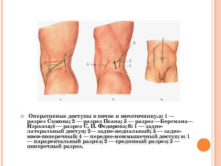  Оперативные доступы к почке и мочеточнику. а: 1 — разрез Симона; 2 —