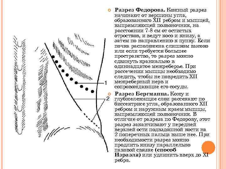  Разрез Федорова. Кожный разрез начинают от вершины угла, образованного XII ребром и мышцей,