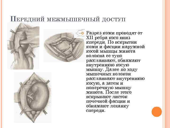 ПЕРЕДНИЙ МЕЖМЫШЕЧНЫЙ ДОСТУП Разрез кожи проводят от XII ребра косо вниз кпереди. По вскрытии