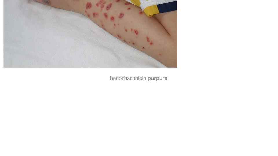 henochschnlein purpura 