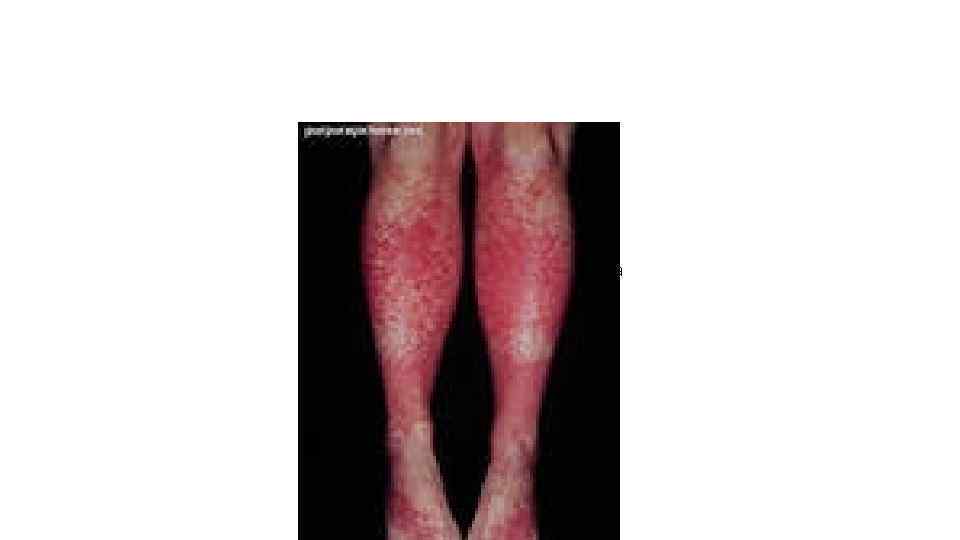 Thrombotic Thrombocytopenic Purpura henochschnlein purpura 