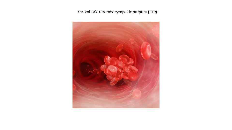 thrombotic thrombocytopenic purpura (TTP) 