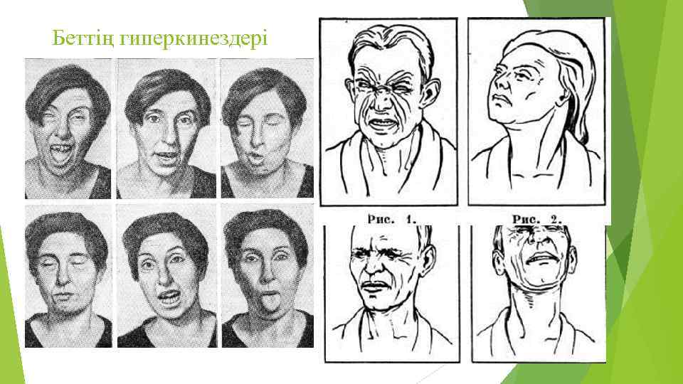 Беттің гиперкинездері 