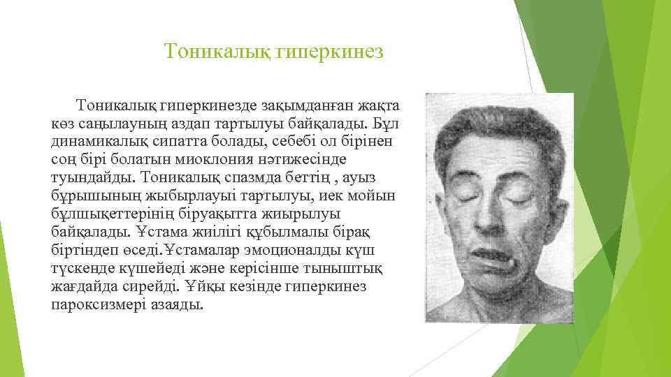 Тоникалық гиперкинезде зақымданған жақта көз саңылауның аздап тартылуы байқалады. Бұл динамикалық сипатта болады, себебі