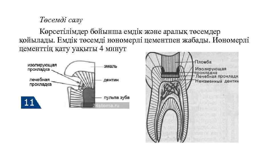 Төсемді салу Көрсетілімдер бойынша емдік және аралық төсемдер қойылады. Емдік төсемді иономерлі цементпен жабады.